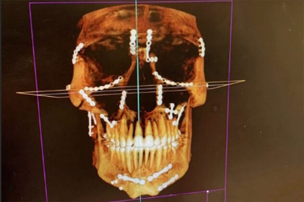 New Weston Peick X-ray images in latest injury update after brutal Paris crash thumbnail