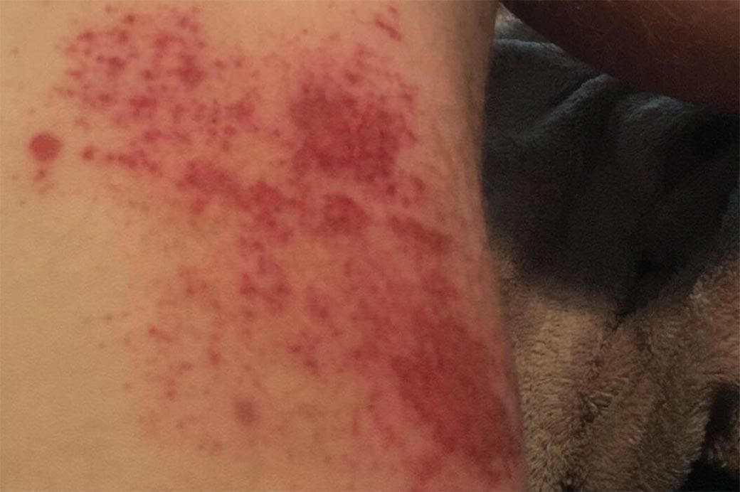 AMA responds to rider anger following San Diego SX chemical burns