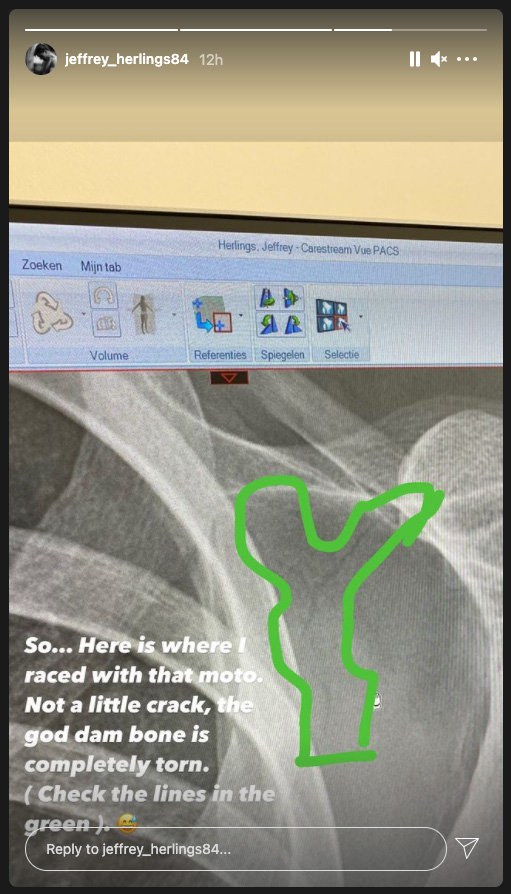 herlings-left-shoulder-fracture-scan-2021-insta